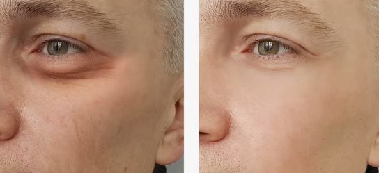 Before &After